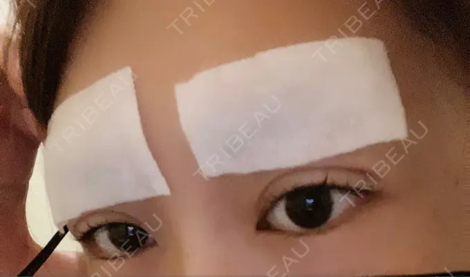 二重埋没 Wクリニック 心斎橋院 DAY 0 メイン用