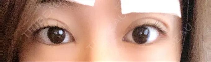 二重埋没 Wクリニック 心斎橋院 DAY 2 メイン用