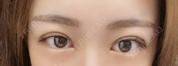 二重埋没 Wクリニック 心斎橋院 DAY 2 メイン用