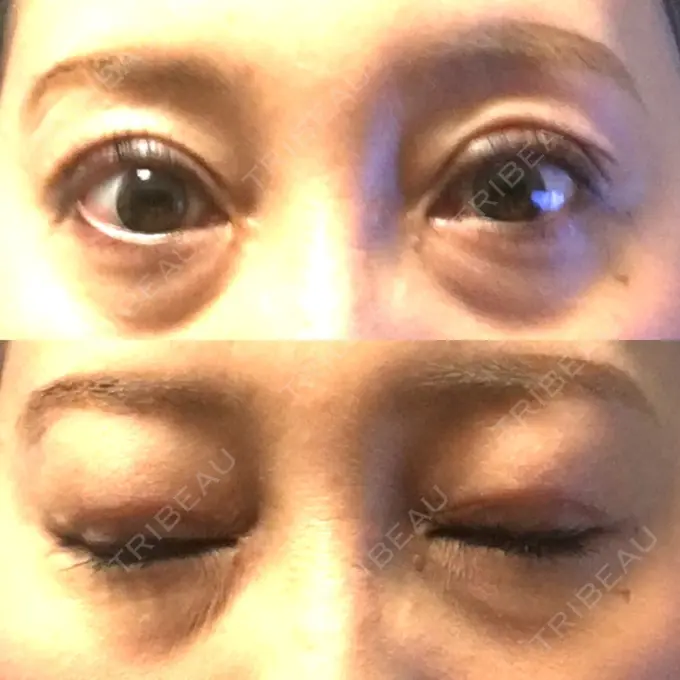 眼瞼下垂（切開） ティーズクリニック DAY 21 メイン用