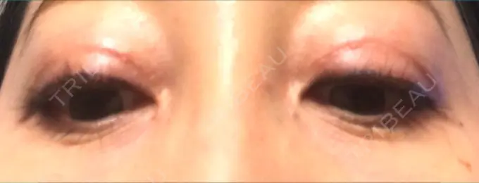 眼瞼下垂（切開） ティーズクリニック DAY 21 メイン用