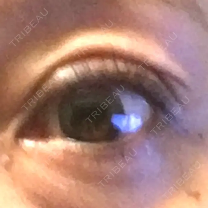 眼瞼下垂（切開） ティーズクリニック DAY 21 メイン用