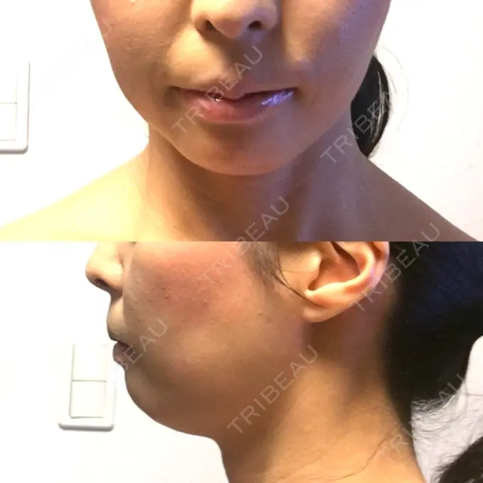 あごプロテーゼ ティーズクリニック DAY 20 メイン用