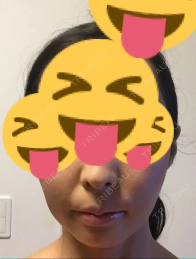 あごプロテーゼ ティーズクリニック DAY 20 メイン用