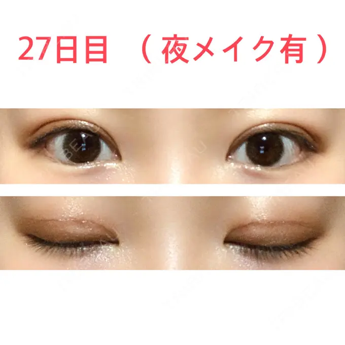 二重切開 水の森美容クリニック 東京新宿院 DAY 27 メイン用