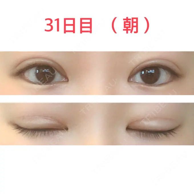 二重切開 水の森美容クリニック 東京新宿院 DAY 31 メイン用