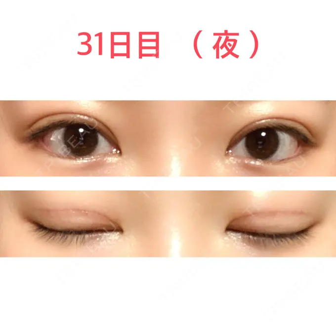 二重切開 水の森美容クリニック 東京新宿院 DAY 31 メイン用