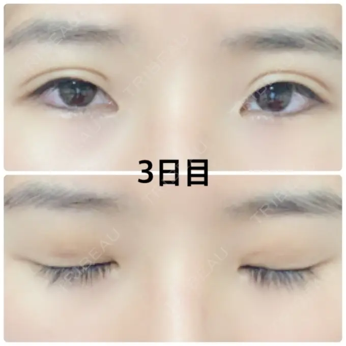 二重埋没 湘南美容クリニック 京都院 DAY 3 メイン用