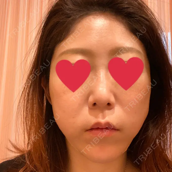 糸リフト 大阪TAクリニック DAY 0 メイン用