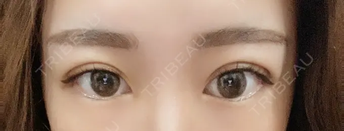 二重埋没 Wクリニック 心斎橋院 AFTER メイン用