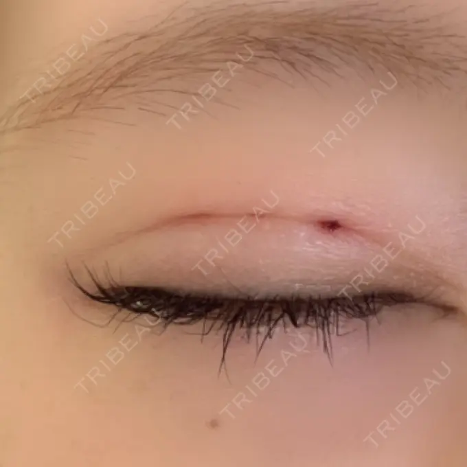 二重埋没 ルネッサンス美容外科医院 神戸院 DAY 1 メイン用