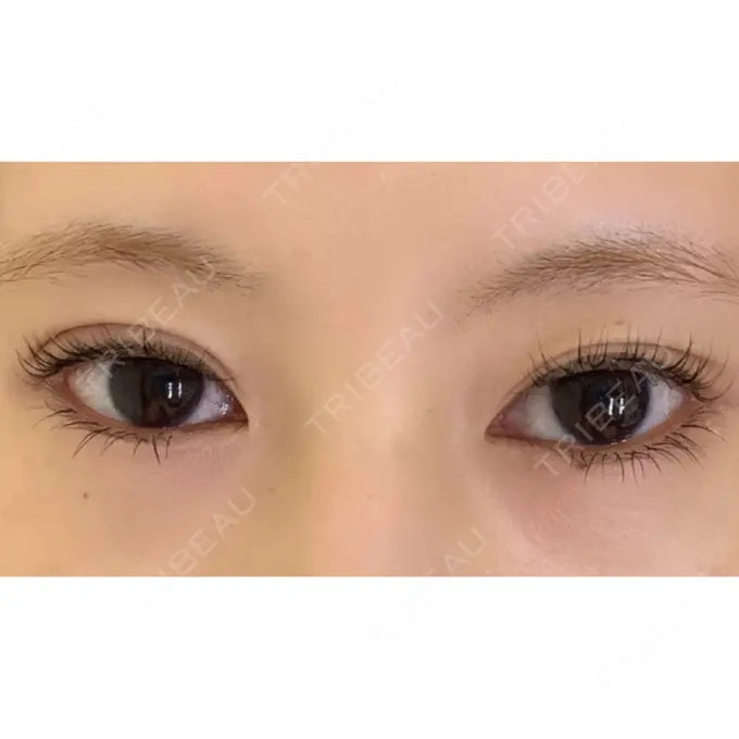 二重埋没 ルネッサンス美容外科医院 神戸院 DAY 1 メイン用