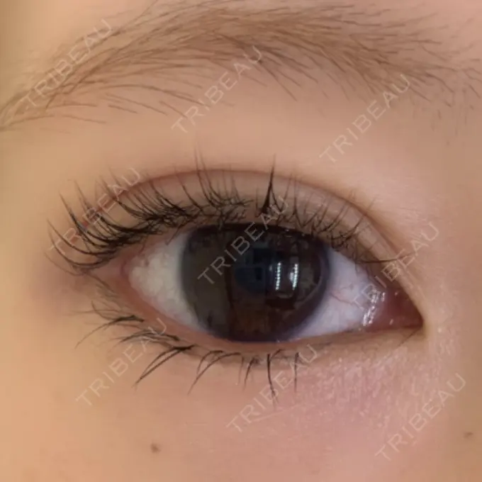 二重埋没 ルネッサンス美容外科医院 神戸院 DAY 1 メイン用