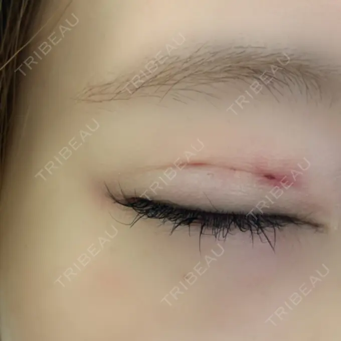 二重埋没 ルネッサンス美容外科医院 神戸院 DAY 2 メイン用