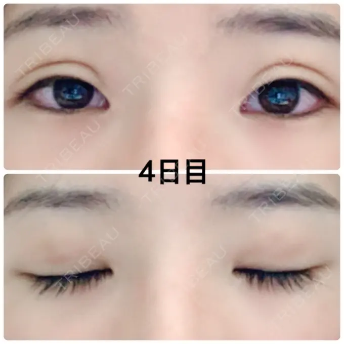 二重埋没 湘南美容クリニック 京都院 DAY 4 メイン用