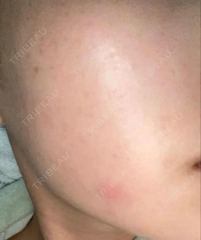 ボトックス（口角） / ピーリング（ニキビ・毛穴） / ピコレーザートーニング（美白・肝斑） 美容皮膚科 369 clinic DAY 62 メイン用