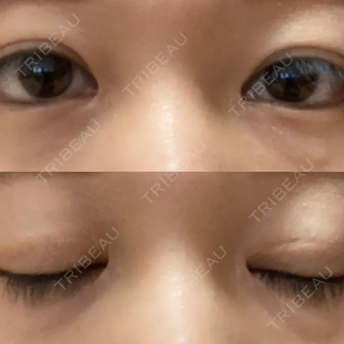 蒙古ひだ形成 / 目元修正 銀座高須クリニック AFTER メイン用