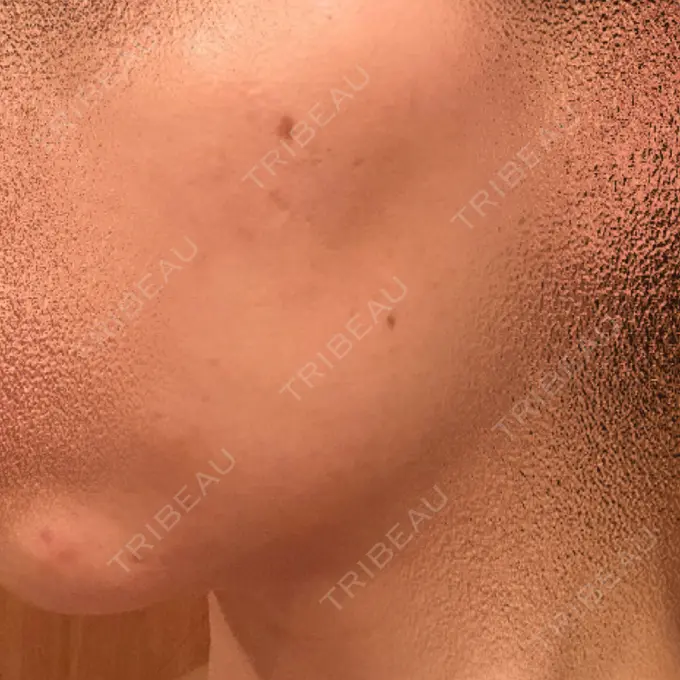 ピーリング（ニキビ・毛穴） / ピコレーザートーニング（美白・肝斑） / YAGレーザー 赤坂ビューティークリニック DAY 15 メイン用