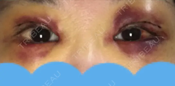 二重切開 みずほクリニック DAY 2 メイン用