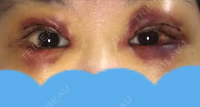 二重切開 みずほクリニック DAY 3 メイン用