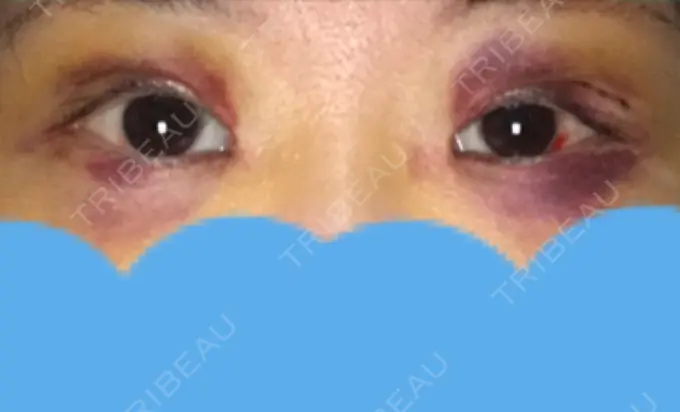 二重切開 みずほクリニック DAY 4 メイン用