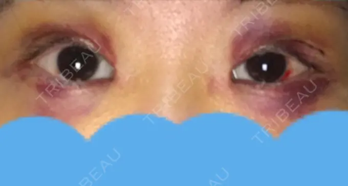 二重切開 みずほクリニック DAY 5 メイン用