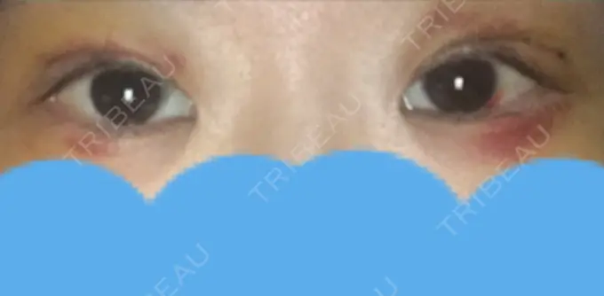 二重切開 みずほクリニック DAY 7 メイン用