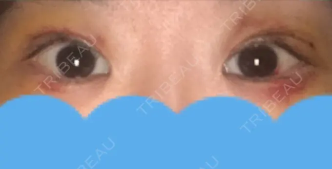 二重切開 みずほクリニック DAY 8 メイン用