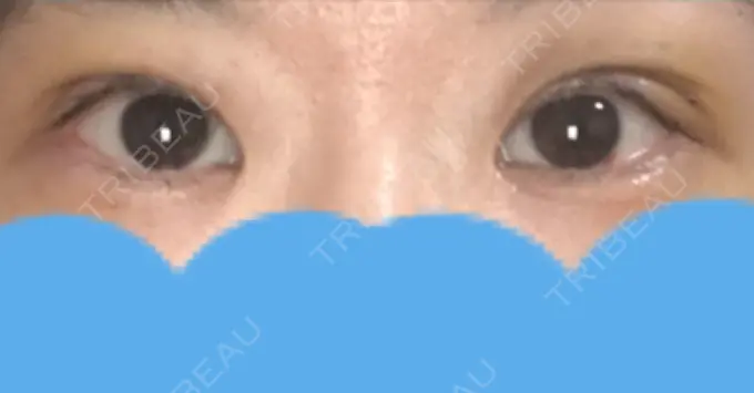 二重切開 みずほクリニック DAY 12 メイン用