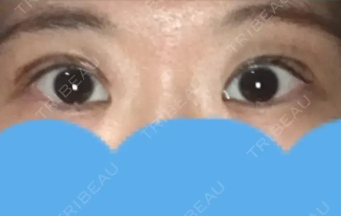 二重切開 みずほクリニック AFTER メイン用