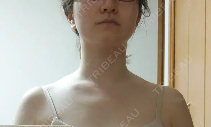 ボトックス（肩） もとび美容外科クリニック 新宿院 DAY 2 メイン用