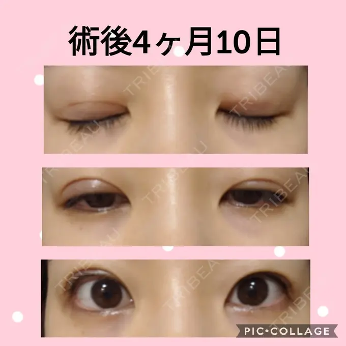 二重切開 マリアクリニック 安城院 AFTER メイン用