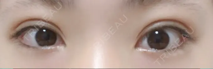 二重埋没 十仁美容整形 DAY 13 メイン用