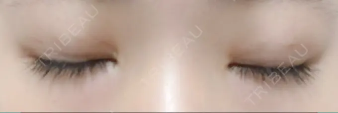 二重埋没 十仁美容整形 DAY 13 メイン用