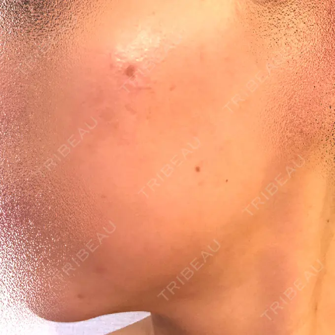 ピーリング（ニキビ・毛穴） / ピコレーザートーニング（美白・肝斑） / YAGレーザー 赤坂ビューティークリニック DAY 18 メイン用