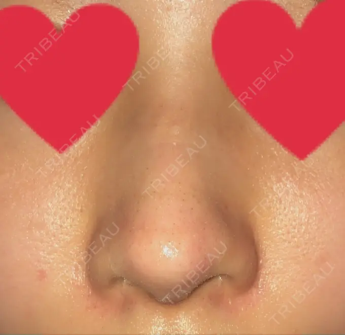 軟骨移植 / 骨切幅寄せ / ワシ鼻修正・ハンプ切除 / 鼻孔縁下降 加美（GAMI）整形外科 AFTER メイン用