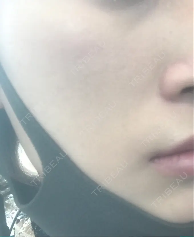 ボトックス（口角） / ピーリング（ニキビ・毛穴） / ピコレーザートーニング（美白・肝斑） 美容皮膚科 369 clinic DAY 66 メイン用