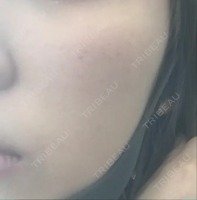 ボトックス（口角） / ピーリング（ニキビ・毛穴） / ピコレーザートーニング（美白・肝斑） 美容皮膚科 369 clinic AFTER メイン用