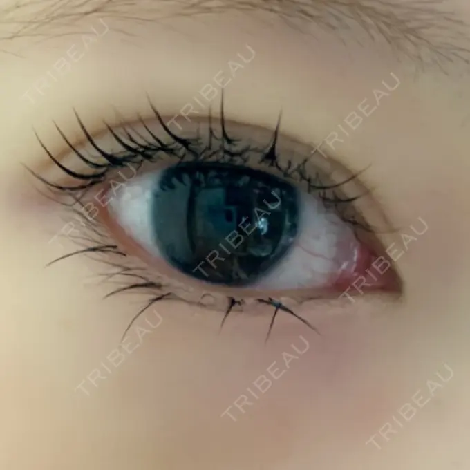 二重埋没 ルネッサンス美容外科医院 神戸院 AFTER メイン用