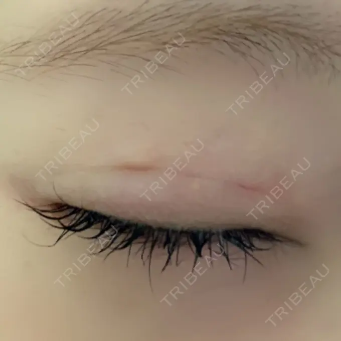 二重埋没 ルネッサンス美容外科医院 神戸院 DAY 7 メイン用