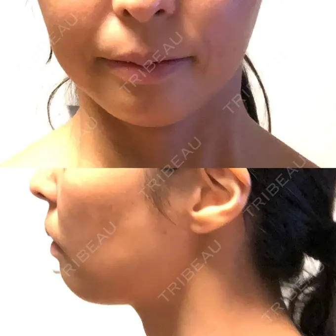 あごプロテーゼ ティーズクリニック AFTER メイン用