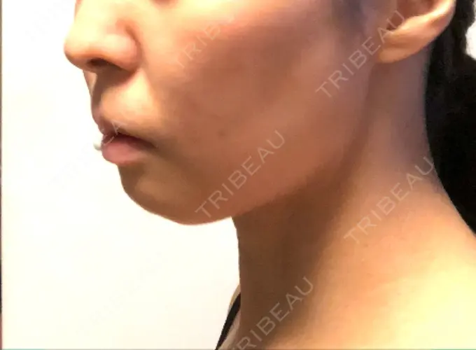 あごプロテーゼ ティーズクリニック DAY 21 メイン用