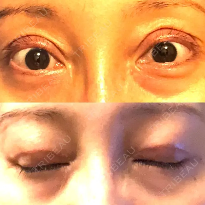 眼瞼下垂（切開） ティーズクリニック DAY 22 メイン用