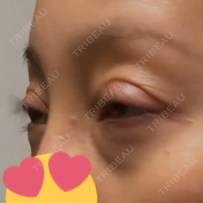 眼瞼下垂（切開） ティーズクリニック DAY 22 メイン用