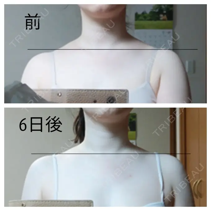 ボトックス（肩） もとび美容外科クリニック 新宿院 DAY 6 メイン用