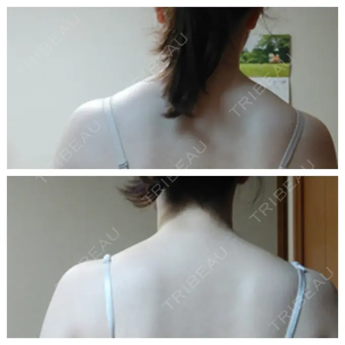 ボトックス（肩） もとび美容外科クリニック 新宿院 DAY 6 メイン用