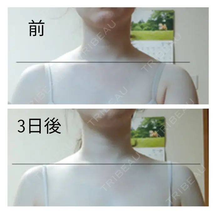 ボトックス（肩） もとび美容外科クリニック 新宿院 DAY 3 メイン用