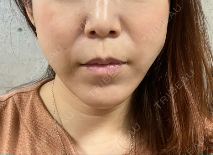 糸リフト 大阪TAクリニック DAY 6 メイン用