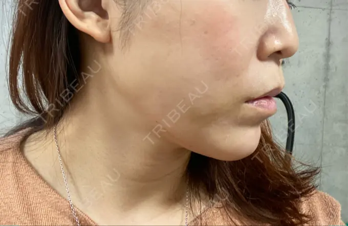 糸リフト 大阪TAクリニック DAY 6 メイン用