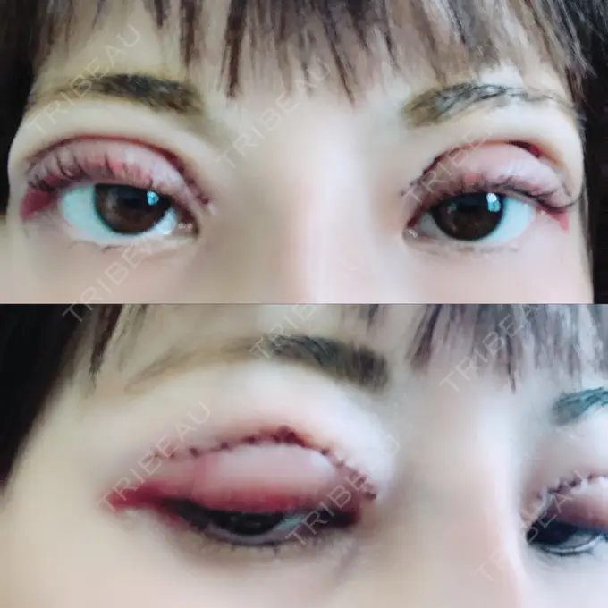 二重切開 / ヒアルロン酸注入（鼻） 品川スキンクリニック沖縄院 DAY 1 メイン用